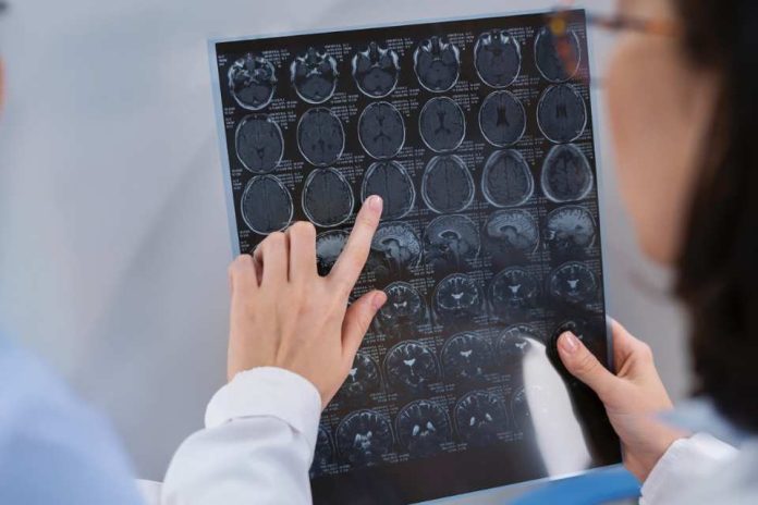 Enfermedades del cerebro: ¿cuáles son las más comunes en Chile?