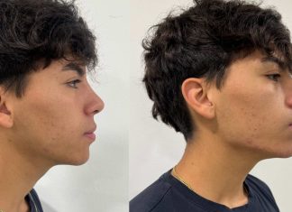Fajas faciales especialistas advierten sobre la moda de moldear la papada mientras se duerme