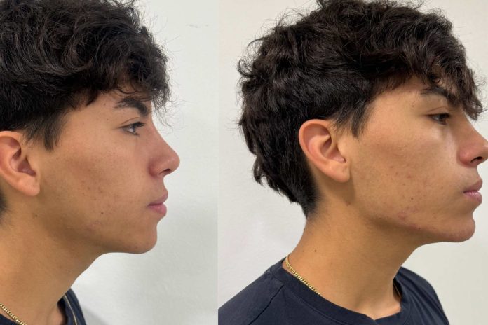 Fajas faciales especialistas advierten sobre la moda de moldear la papada mientras se duerme