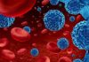 Leucemia mieloide aguda: urgencia nacional por mejorar el diagnóstico y acceso a tratamientos para pacientes