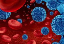 Leucemia mieloide aguda: urgencia nacional por mejorar el diagnóstico y acceso a tratamientos para pacientes