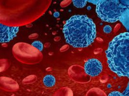 Leucemia mieloide aguda: urgencia nacional por mejorar el diagnóstico y acceso a tratamientos para pacientes