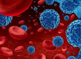 Leucemia mieloide aguda: urgencia nacional por mejorar el diagnóstico y acceso a tratamientos para pacientes