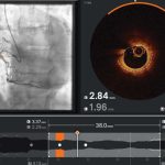 Ultreon 2.0 llega a Chile: la innovadora tecnología de inteligencia artificial para combatir las enfermedades cardiovasculares
