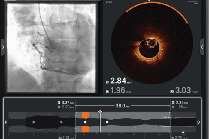 Ultreon 2.0 llega a Chile: la innovadora tecnología de inteligencia artificial para combatir las enfermedades cardiovasculares