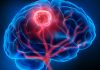 Investigadores de Mayo Clinic revelan un enfoque personalizado para el monitoreo del cáncer de cerebro