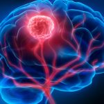 Investigadores de Mayo Clinic revelan un enfoque personalizado para el monitoreo del cáncer de cerebro