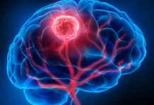Investigadores de Mayo Clinic revelan un enfoque personalizado para el monitoreo del cáncer de cerebro