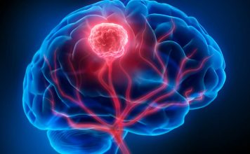 Investigadores de Mayo Clinic revelan un enfoque personalizado para el monitoreo del cáncer de cerebro
