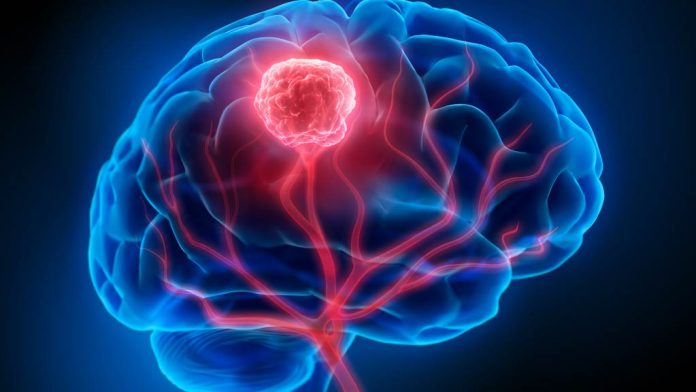 Investigadores de Mayo Clinic revelan un enfoque personalizado para el monitoreo del cáncer de cerebro