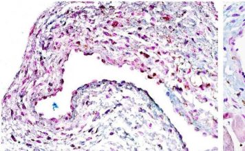 Células madre pueden ofrecer una nueva esperanza para el tratamiento de la enfermedad renal terminal