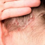 El efecto dominó más allá de la piel El efecto dominó más allá de la piel