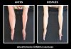 El linfedema: la consecuencia silenciosa del cáncer de mama que requiere visibilidad