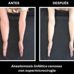 El linfedema: la consecuencia silenciosa del cáncer de mama que requiere visibilidad