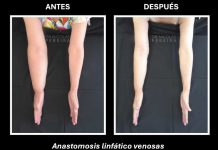 El linfedema: la consecuencia silenciosa del cáncer de mama que requiere visibilidad