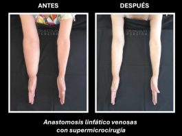 El linfedema: la consecuencia silenciosa del cáncer de mama que requiere visibilidad