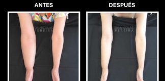 El linfedema: la consecuencia silenciosa del cáncer de mama que requiere visibilidad