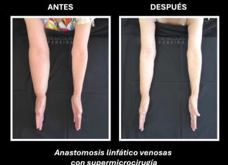 El linfedema: la consecuencia silenciosa del cáncer de mama que requiere visibilidad