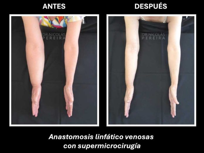 El linfedema: la consecuencia silenciosa del cáncer de mama que requiere visibilidad