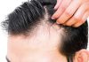 Fin al trauma de la alopecia en hombres