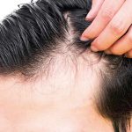 Fin al trauma de la alopecia en hombres