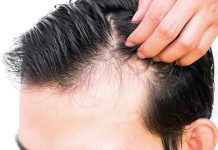 Fin al trauma de la alopecia en hombres