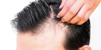 Fin al trauma de la alopecia en hombres