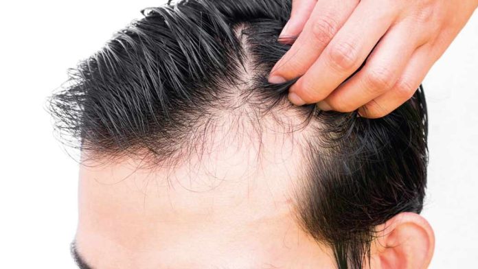 Fin al trauma de la alopecia en hombres