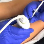 Hospital Roberto del Río utiliza bótox para transformar la movilidad de niños con parálisis cerebral