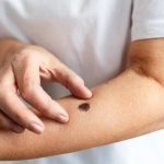 Inicio de la temporada de la araña de rincón: Cómo actuar y cuándo acudir a urgencias ante una picadura Inicio de la temporada de la araña de rincón: Cómo actuar y cuándo acudir a urgencias ante una picadura