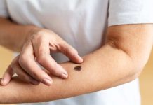 Inicio de la temporada de la araña de rincón: Cómo actuar y cuándo acudir a urgencias ante una picadura Inicio de la temporada de la araña de rincón: Cómo actuar y cuándo acudir a urgencias ante una picadura