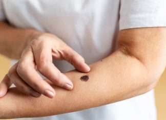 Inicio de la temporada de la araña de rincón: Cómo actuar y cuándo acudir a urgencias ante una picadura