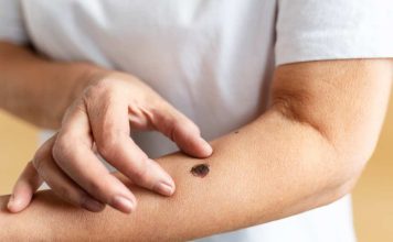 Inicio de la temporada de la araña de rincón: Cómo actuar y cuándo acudir a urgencias ante una picadura Inicio de la temporada de la araña de rincón: Cómo actuar y cuándo acudir a urgencias ante una picadura