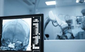 Cirugías cerebrales por vía nasal una técnica cada vez más frecuente y menos invasiva