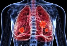 Novedades en el tratamiento del cáncer de pulmón: nuevas indicaciones alcanzaron reducciones significativas en progresión o muerte en comparación con la terapia convencional Novedades en el tratamiento del cáncer de pulmón: nuevas indicaciones alcanzaron reducciones significativas en progresión o muerte en comparación con la terapia convencional