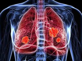 Novedades en el tratamiento del cáncer de pulmón: nuevas indicaciones alcanzaron reducciones significativas en progresión o muerte en comparación con la terapia convencional Novedades en el tratamiento del cáncer de pulmón: nuevas indicaciones alcanzaron reducciones significativas en progresión o muerte en comparación con la terapia convencional