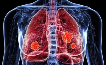 Novedades en el tratamiento del cáncer de pulmón: nuevas indicaciones alcanzaron reducciones significativas en progresión o muerte en comparación con la terapia convencional Novedades en el tratamiento del cáncer de pulmón: nuevas indicaciones alcanzaron reducciones significativas en progresión o muerte en comparación con la terapia convencional