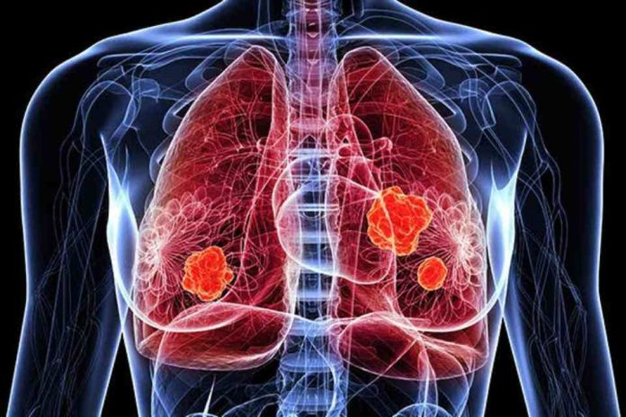 Novedades en el tratamiento del cáncer de pulmón nuevas indicaciones alcanzaron reducciones significativas en progresión o muerte en comparación con la terapia convencional Novedades en el tratamiento del cáncer de pulmón: nuevas indicaciones alcanzaron reducciones significativas en progresión o muerte en comparación con la terapia convencional