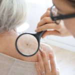 Nueva prueba genómica podría evitar que algunas personas con melanoma se sometan a la cirugía de biopsia de ganglio linfático