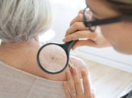 Nueva prueba genómica podría evitar que algunas personas con melanoma se sometan a la cirugía de biopsia de ganglio linfático