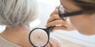 Nueva prueba genómica podría evitar que algunas personas con melanoma se sometan a la cirugía de biopsia de ganglio linfático