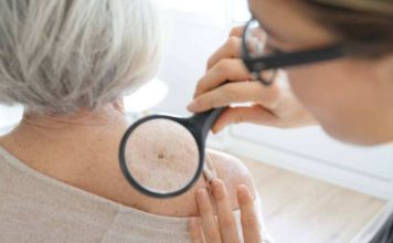 Nueva prueba genómica podría evitar que algunas personas con melanoma se sometan a la cirugía de biopsia de ganglio linfático