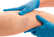Várices: cómo enfrentar el trastorno venoso crónico que afecta a más del 30% de la población chilena