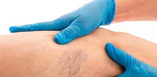 Várices: cómo enfrentar el trastorno venoso crónico que afecta a más del 30% de la población chilena