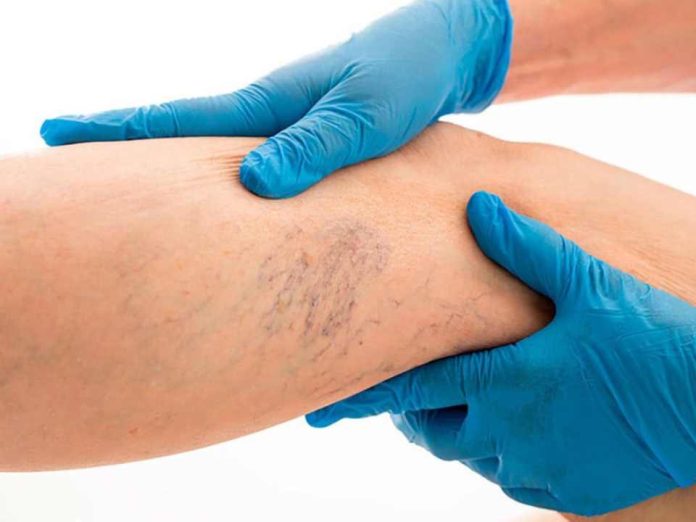 Várices: cómo enfrentar el trastorno venoso crónico que afecta a más del 30% de la población chilena