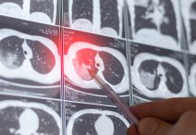 Cáncer de pulmón: la importancia del screening en fumadores y exfumadores