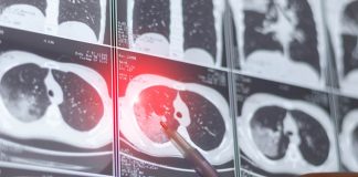 Cáncer de pulmón: la importancia del screening en fumadores y exfumadores