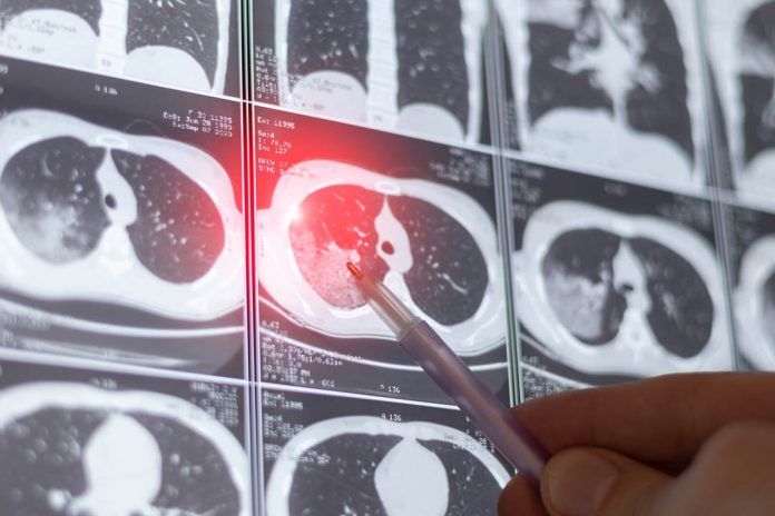 Cáncer de pulmón: la importancia del screening en fumadores y exfumadores