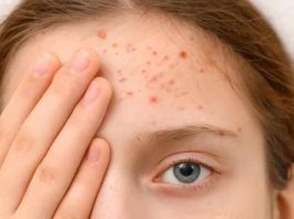 Caso de sarampión en Chile ¿Qué tan contagioso es el virus y a quiénes afecta más?