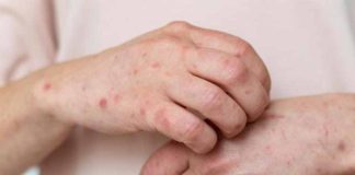 MINSAL informa caso importado de sarampión en Chile